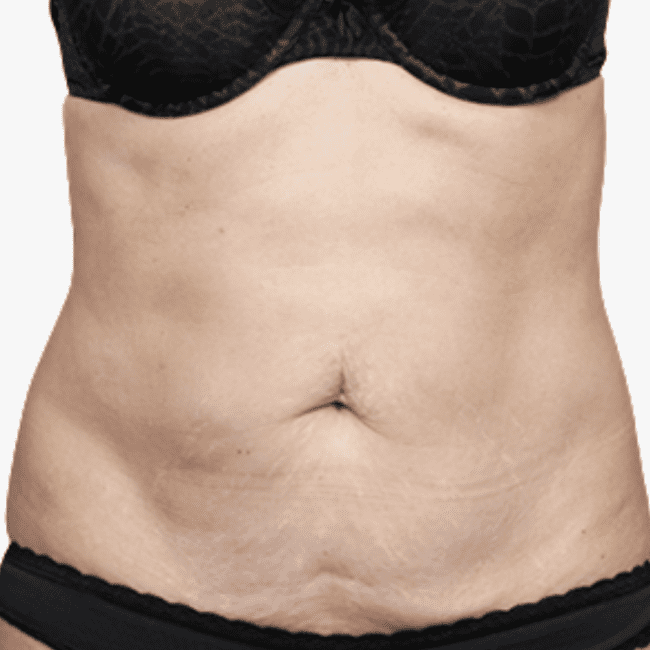 Emsculpt Neo Before and After - Case 6, Image 1 - Female, age 25 – 34 Novare Wellness & Aesthetics